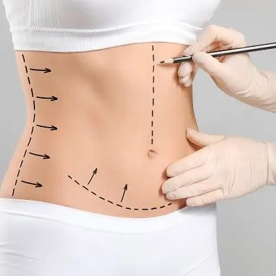 Abdominoplasty