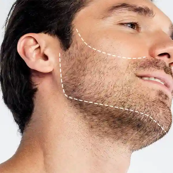 Beard Transplant